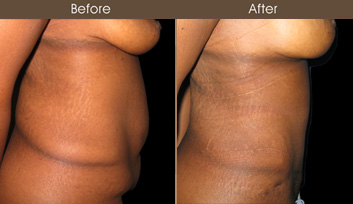 NYC Abdominoplasty Surgery Before And After